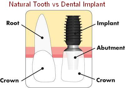 What is the difference between Natural Teeth & Dental Implant - Pittsburgh PA