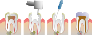 How a root canal is proformed on a Molar. 
