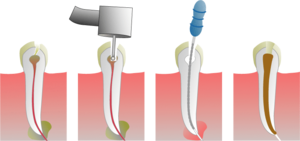 How a root canal is proformed.